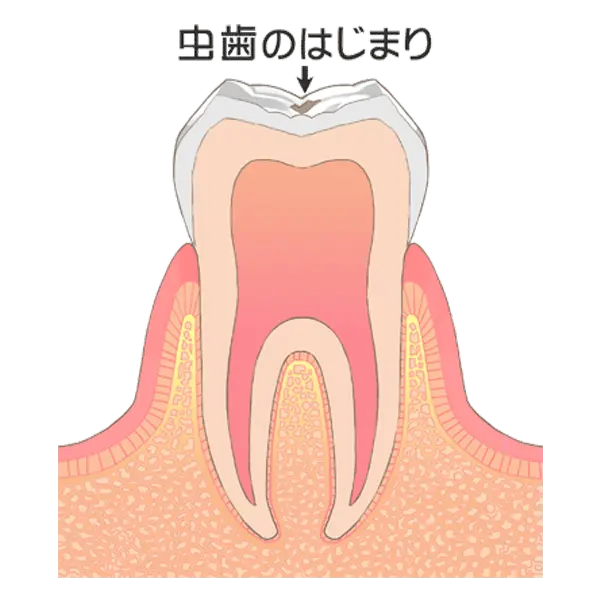 初期の脱灰状態