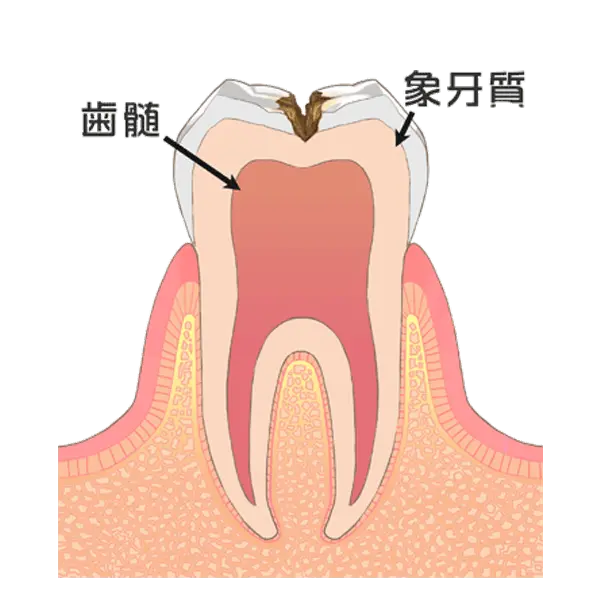 象牙質まで進んだ虫歯