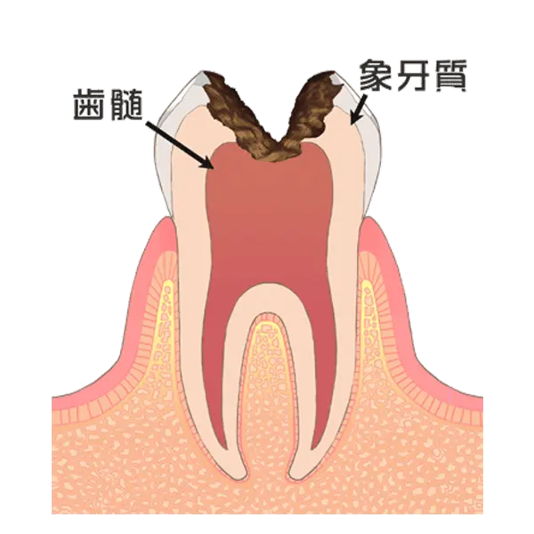 歯の神経に達した虫歯