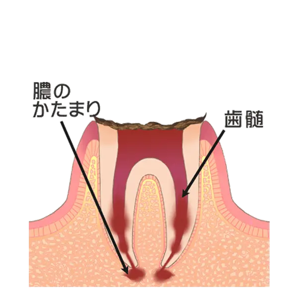 歯の根にまで及んだ虫歯
