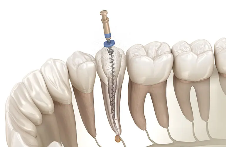 根管治療