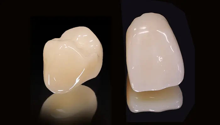 クラウン（被せ物）