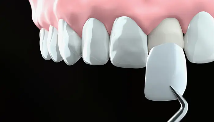  ラミネートベニア