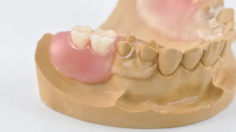 ノンクラスプデンチャー