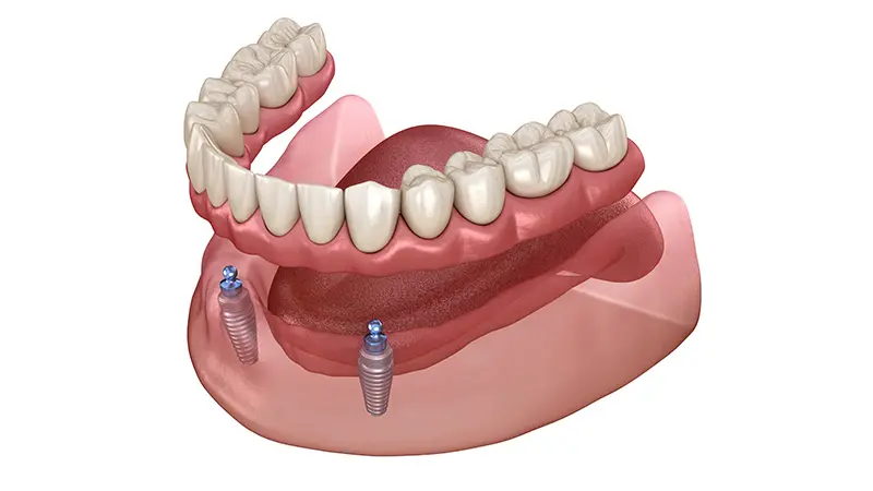 インプラントオーバーデンチャー