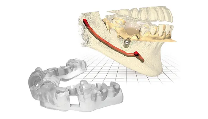 正確性を高めた安心の手術
