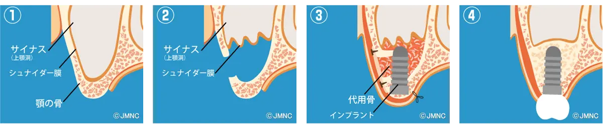 サイナスリフト法