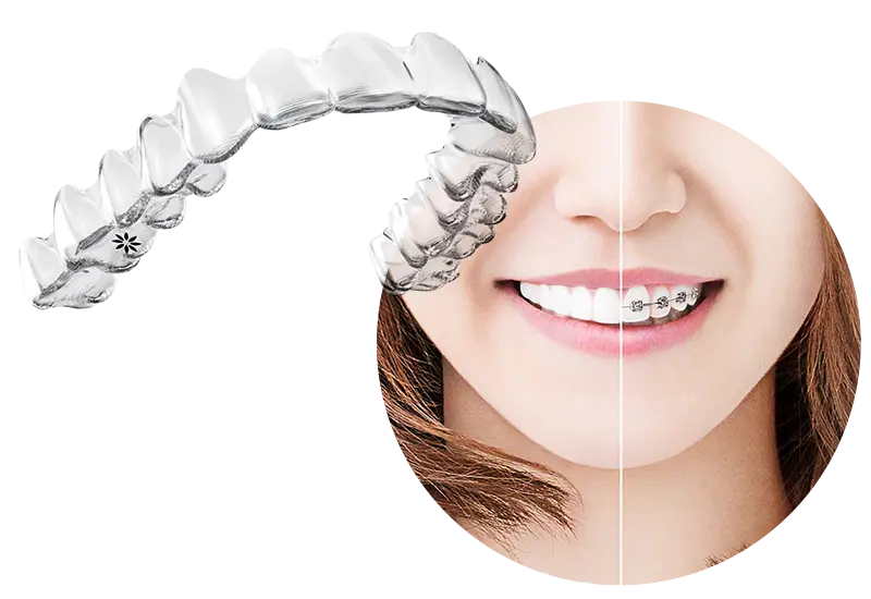 インビザライン