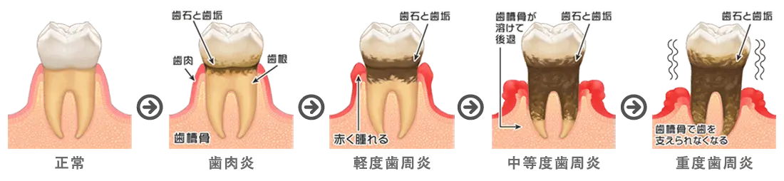 歯周病の進行