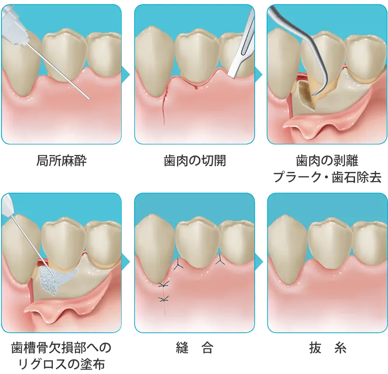 歯周組織再生療法