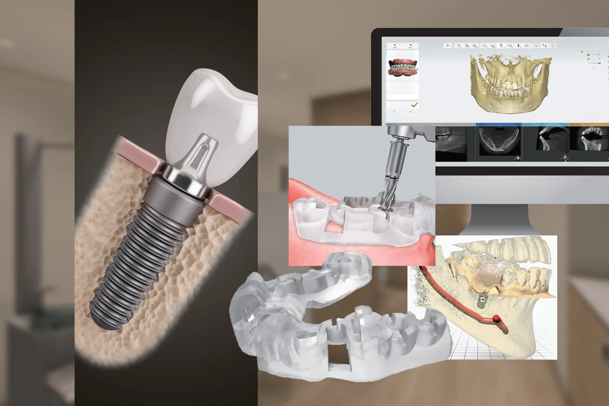 インプラント認定医専修医